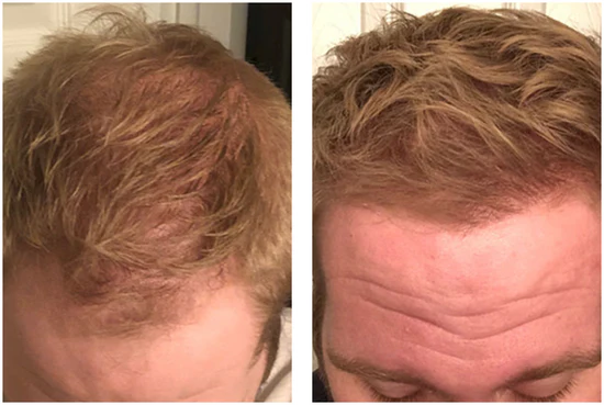 LOVILDS™ Clinically Backed Hair Regrowth Formula Trusted by Experts