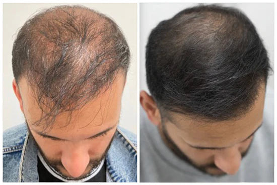 LOVILDS™ Clinically Backed Hair Regrowth Formula Trusted by Experts
