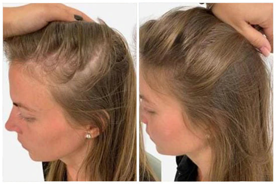 LOVILDS™ Clinically Backed Hair Regrowth Formula Trusted by Experts